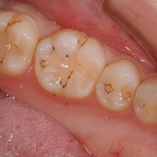 奥歯の虫歯治療